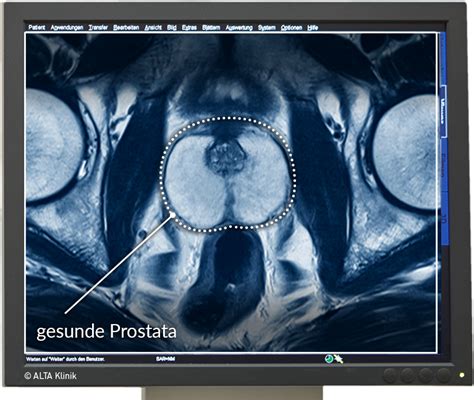 rostata|prostata bei frauen.